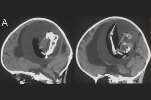 Imagem ilustrativa da imagem Bebê passa por cirurgia para retirar feto de irmão gêmeo do crânio