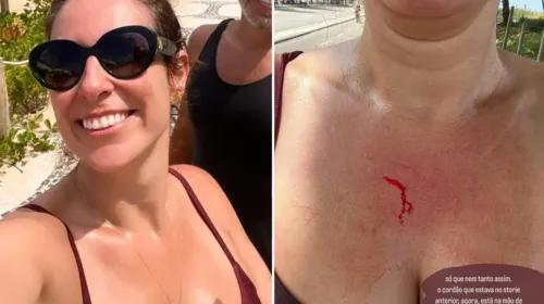 A fisioterapeuta Natasha Dantas mostrou o corte com sangue na região do colo provocado pelo assaltante