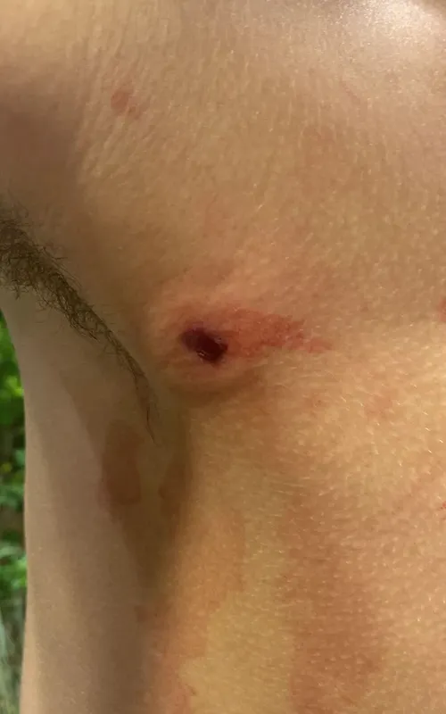 Tiro acertou na axila do adolescente