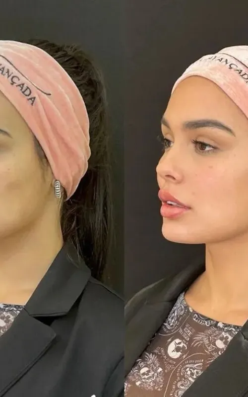 Antes e depois da harmonização facial