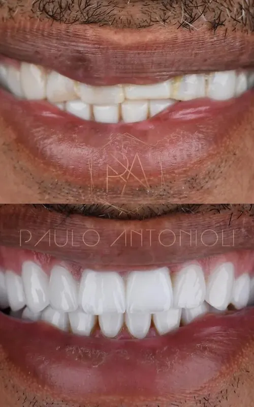 Antes e depois do procedimento estético de Manoel Gomes