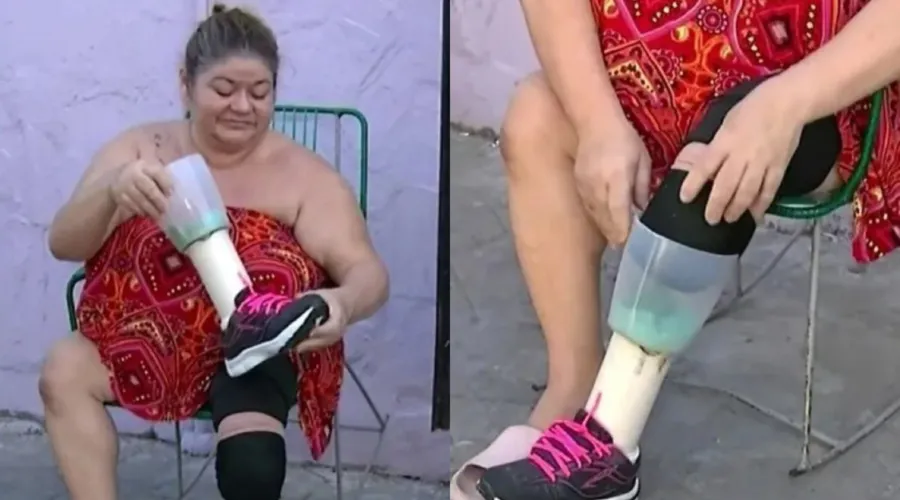 Mulher criou prótese em casa após não receber a sua pela prefeitura