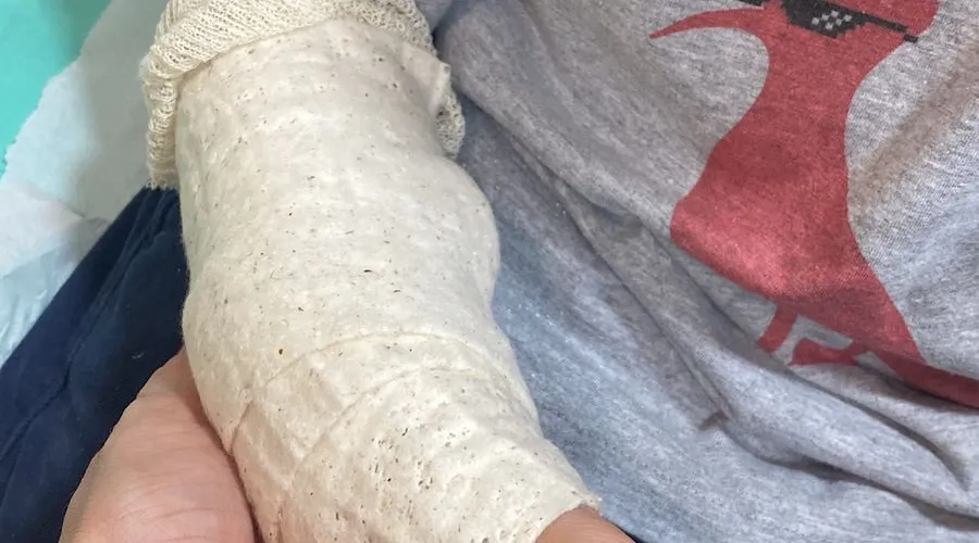 Criança de 7 anos teve um dos braços quebrados no acidente