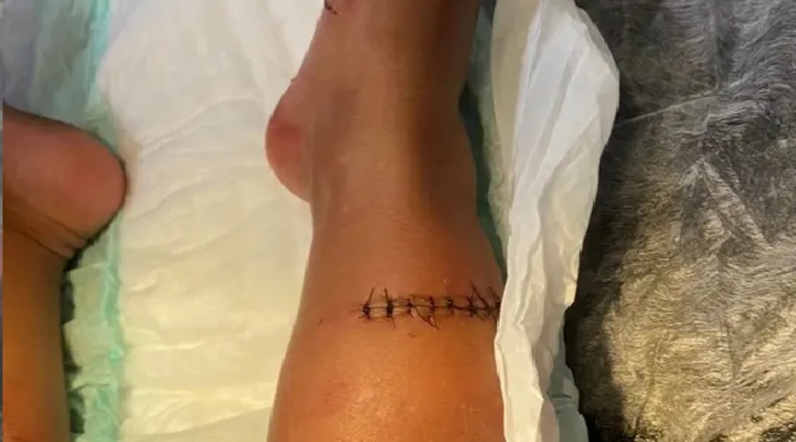 Uma das pernas da criança após ser suturada