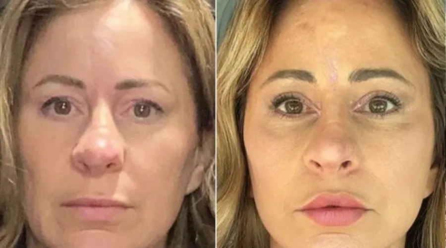 Kelly Beasley, de 50 anos, antes e depois de procedimentos estéticos para 'rejuvenescer 20 anos'