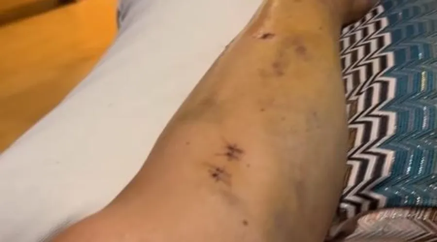 Artista quebrou a perna em quatro lugares