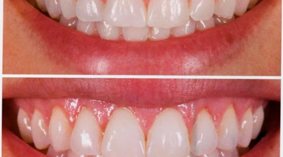 A principal diferença entre faceta e lente de contato dental é a espessura da peça