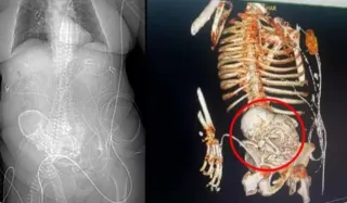 Imagem ilustrativa da imagem Idosa de 81 anos descobre um 'bebê de pedra' no ventre