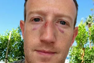 Imagem ilustrativa da imagem Mark Zuckerberg posta foto com rosto machucado e vira meme