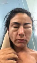 Imagem ilustrativa da imagem Vídeo mostra jovem com rosto deformado por comer camarão no Rio