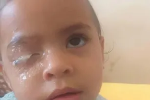 Imagem ilustrativa da imagem Menina de 2 anos gruda o olho com cola e vai parar no hospital