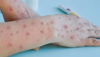 Imagem ilustrativa da imagem Ministro da Saúde anuncia antiviral para tratar varíola dos macacos