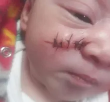 Imagem ilustrativa da imagem Bebê tem rosto cortado durante nascimento e leva cinco pontos