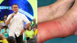 Imagem ilustrativa da imagem Saiba como é a doença que não deixa Bolsonaro usar calças