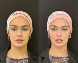 Imagem ilustrativa da imagem 'Bem sutil', diz Larissa Santos após harmonização facial; veja