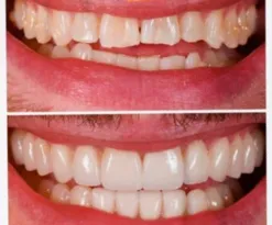 Imagem ilustrativa da imagem Sorriso de BBB: saiba quanto custa colocar lentes nos dentes