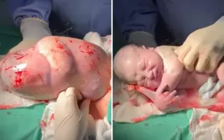 Imagem ilustrativa da imagem Bebê nasce dormindo e coberto pela bolsa amniótica; vídeo