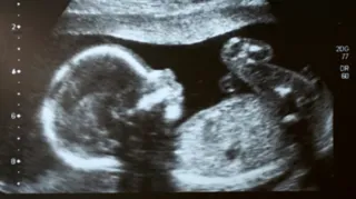 Imagem ilustrativa da imagem Bebê nasce com duas genitálias e sem ânus; entenda