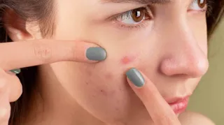 Imagem ilustrativa da imagem Médicos alertam para uso indevido de remédio para acnes