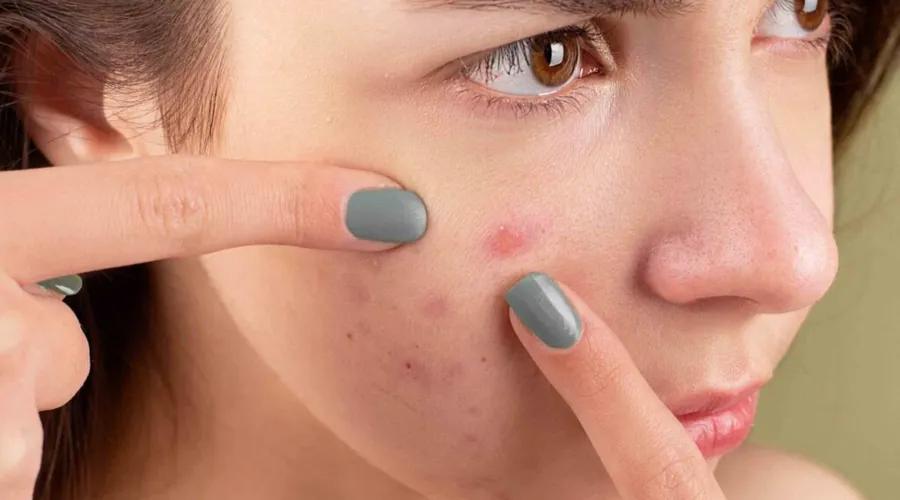 Imagem ilustrativa da imagem Médicos alertam para uso indevido de remédio para acnes