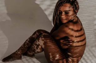 Imagem ilustrativa da imagem Representatividade: conheça mais sobre o vitiligo, doença de participante do BBB