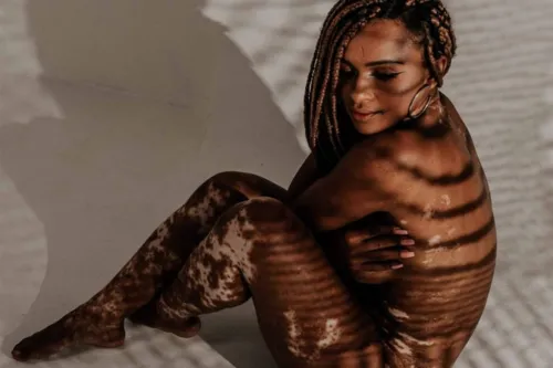 Imagem ilustrativa da imagem Representatividade: conheça mais sobre o vitiligo, doença de participante do BBB